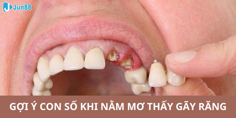 Nằm mơ thấy gãy răng là một giấc mộng không quá xấu. Vậy nên các bạn không cần phải quá lo lắng, ý nghĩa cụ thể sẽ được nhà cái JUN88 đề cập ngay bên dưới. 